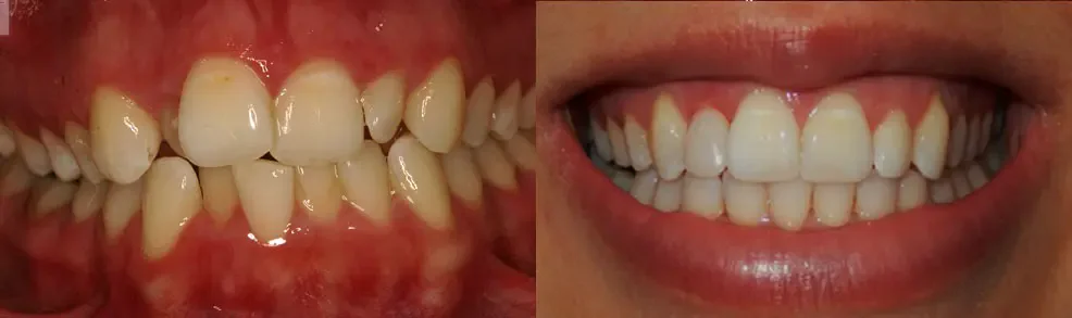 A patient before and after treatment: straightened front teeth