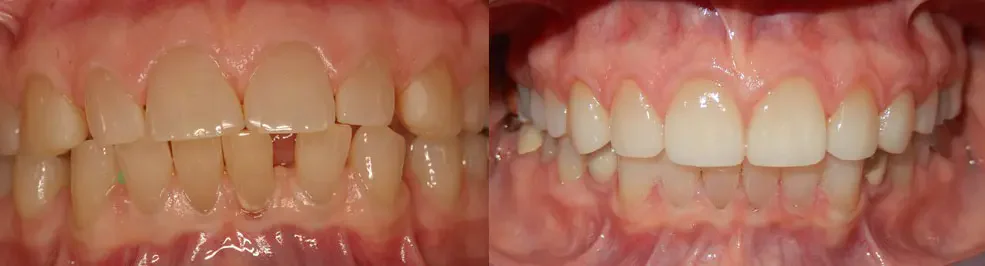 A patient before and after treatment: a brighter, even smile