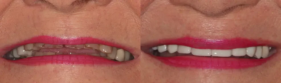 A patient before and after treatment: restored front teeth