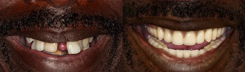 A patient before and after treatment: gaps closed and teeth restored