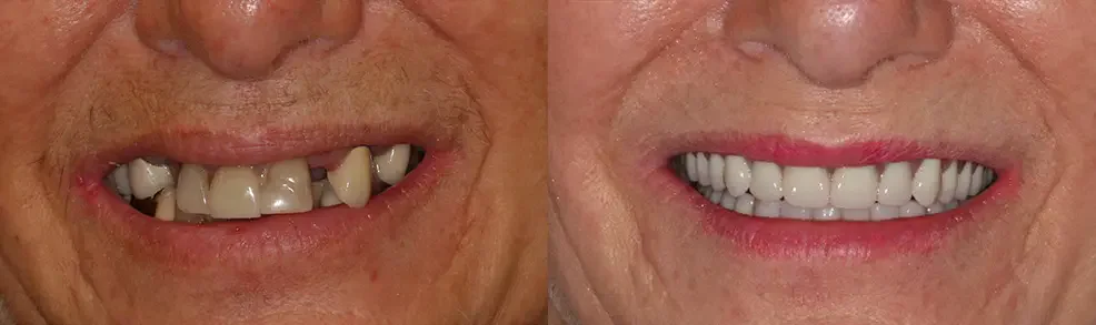 A patient before and after treatment: a full smile restored
